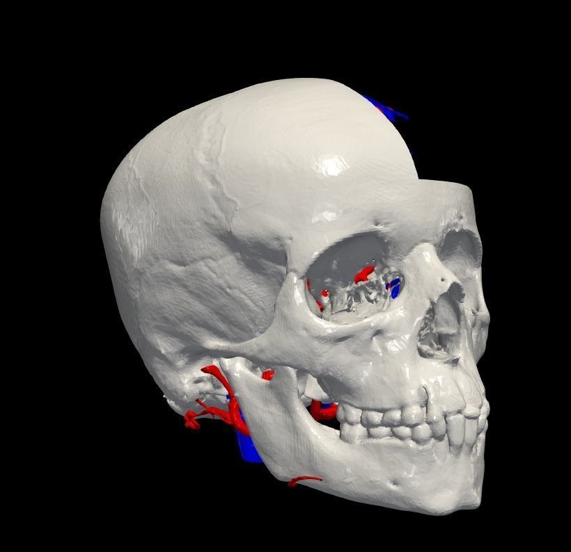 3D Model of Brain Arteriovenous Malformation 3D print model_6