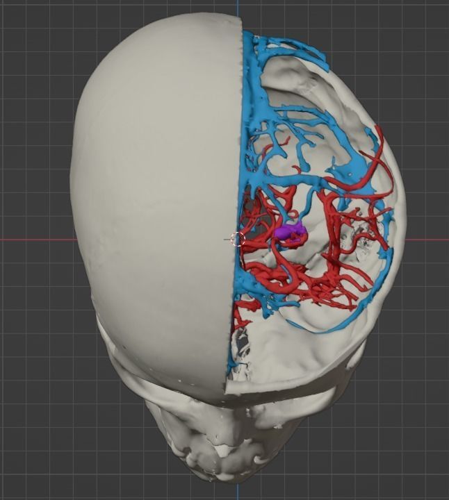 3D Model of Brain Arteriovenous Malformation 3D print model_10