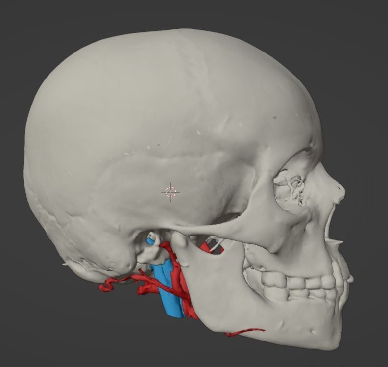 3D Model of Brain Arteriovenous Malformation 3D print model_11