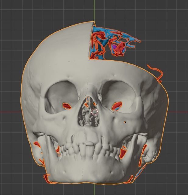 3D Model of Brain Arteriovenous Malformation 3D print model_14