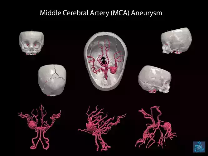 3D Model of Middle Cerebral Artery Aneurysm