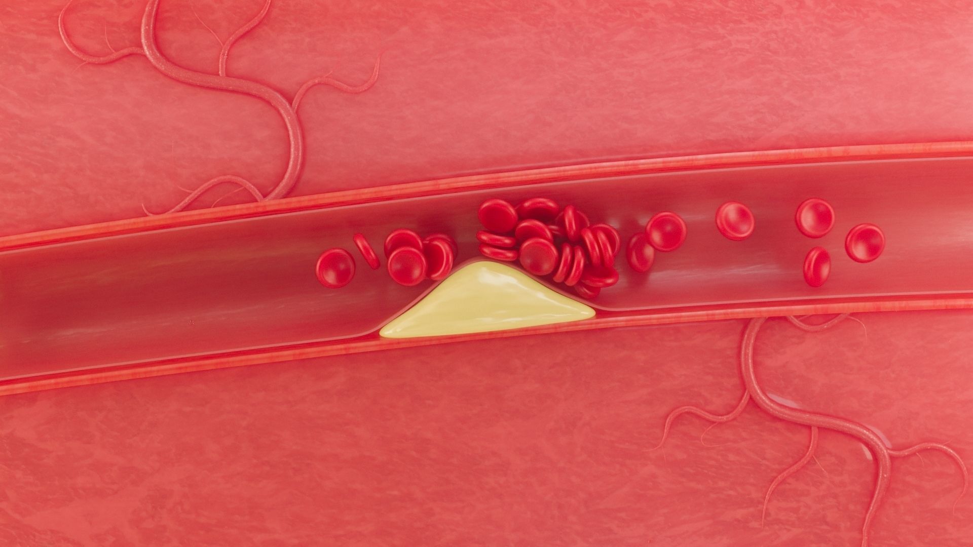 Blood Vascular blockage 3D model_2