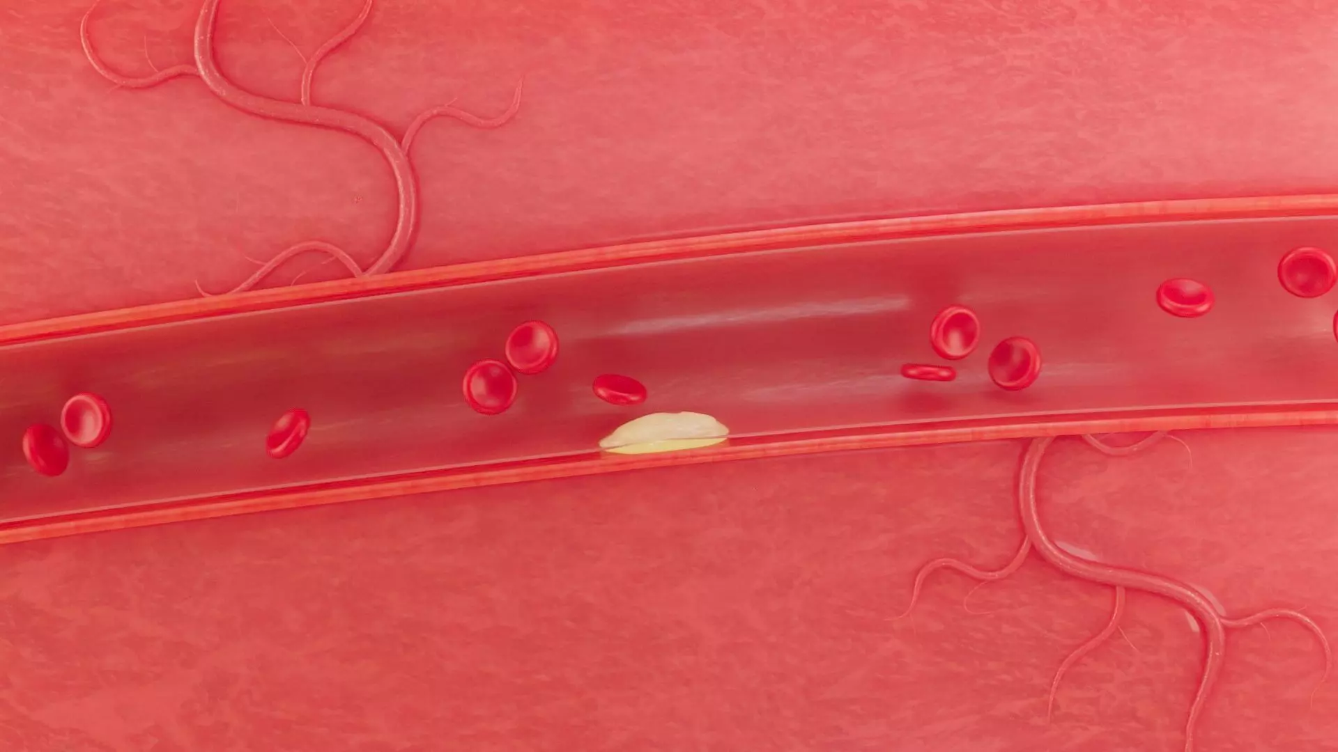 Blood Vascular blockage 3D model_0