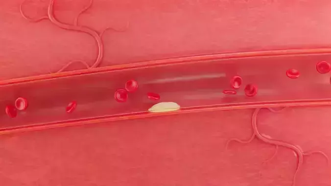 Blood Vascular blockage