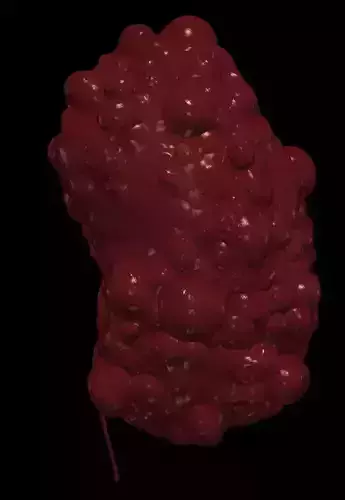 3D Model of Polycystic Kidney