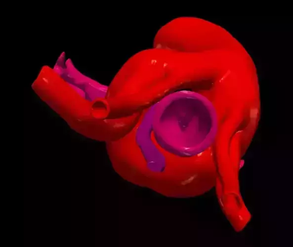 3D Model of Double Aortic Arch and Trachea 3D model