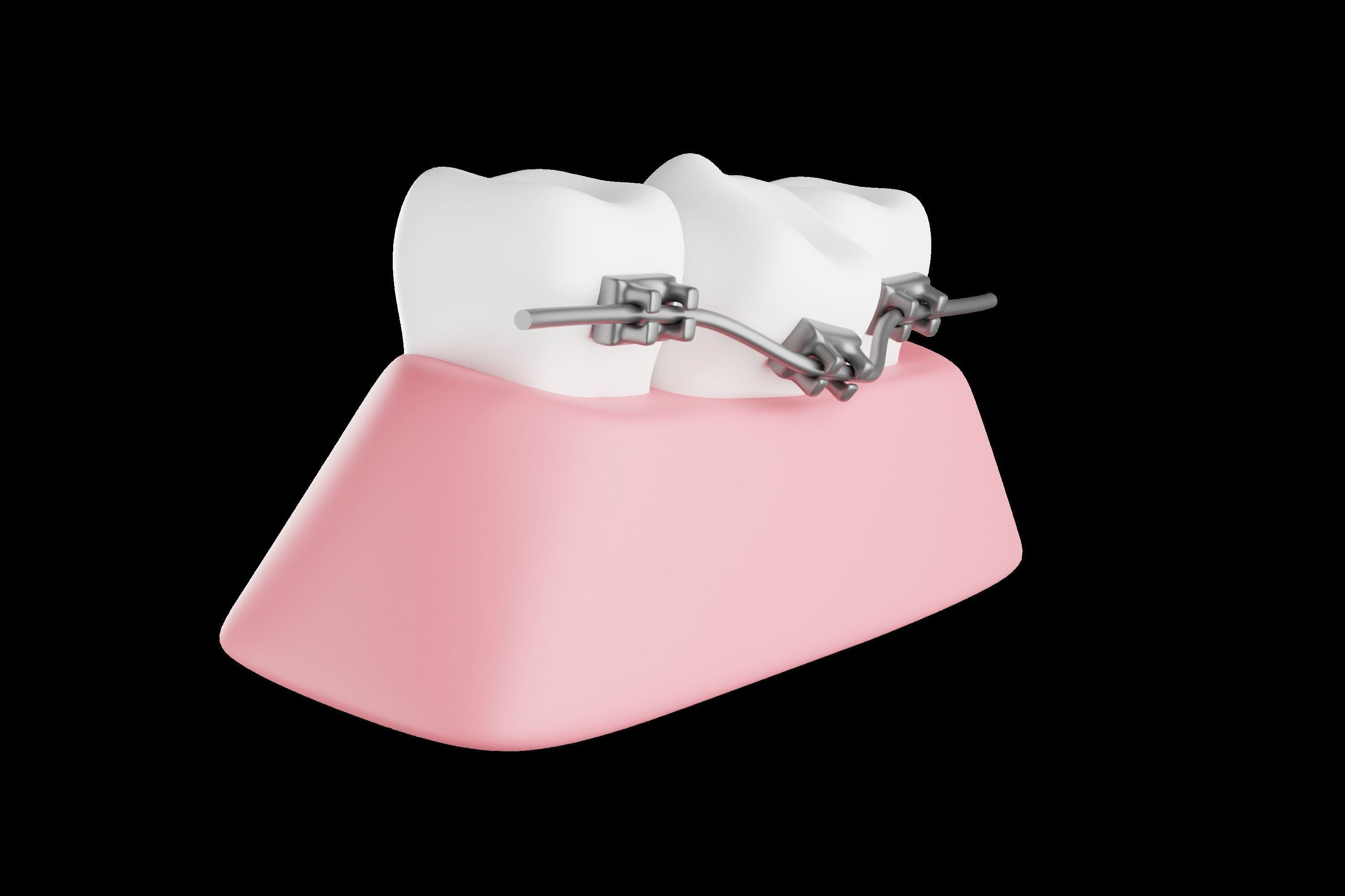 Dental braces system for bite correction 3D model_1