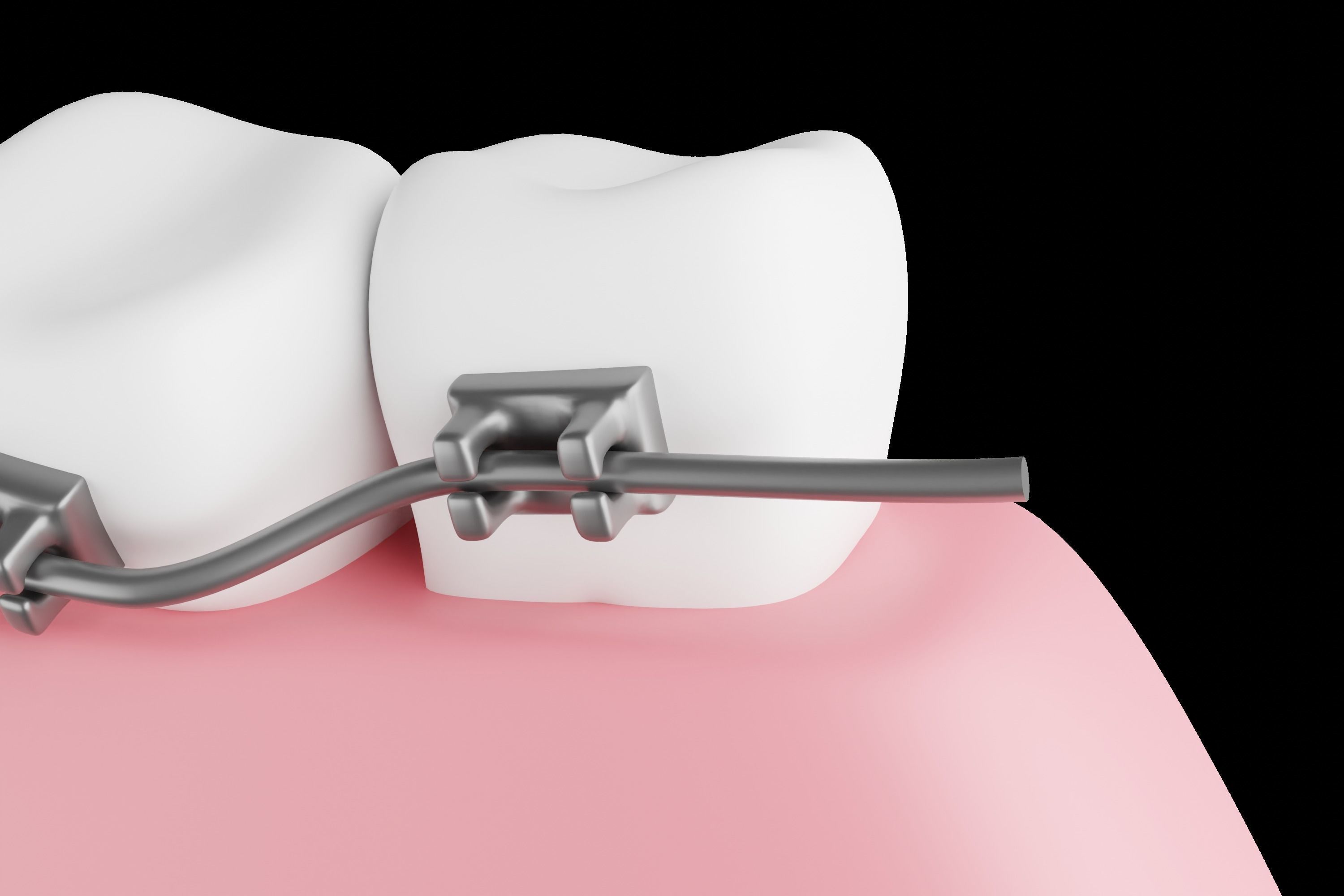 Dental braces system for bite correction 3D model_4