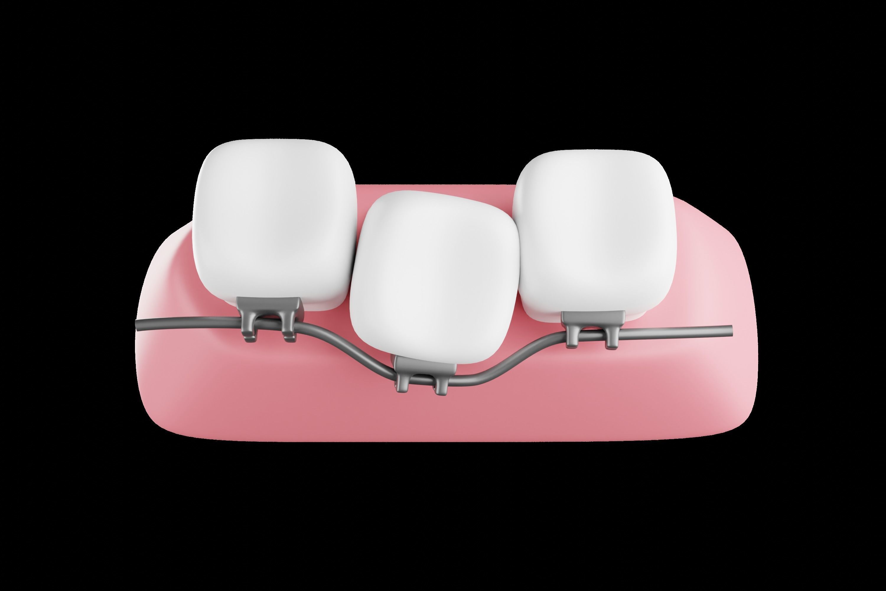Dental braces system for bite correction 3D model_3
