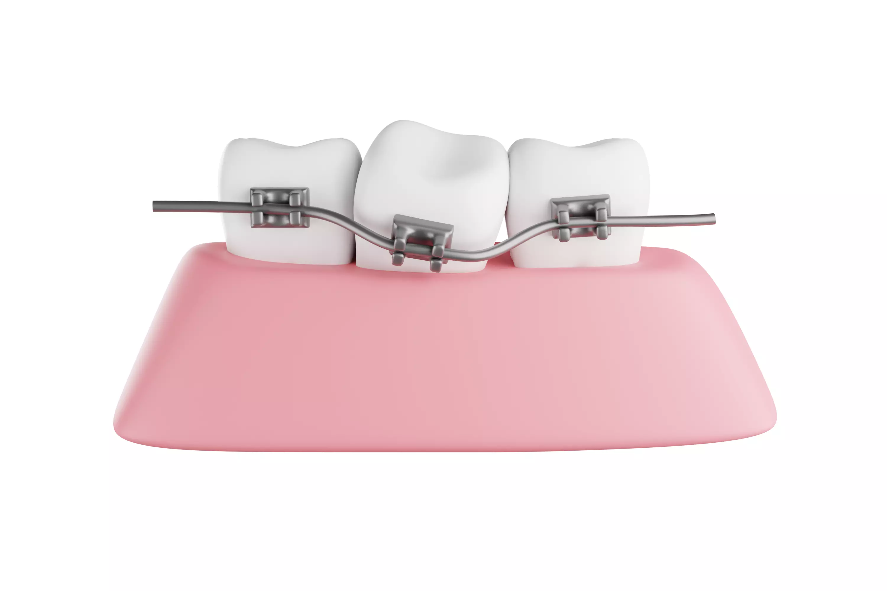 Dental braces system for bite correction 3D model_0