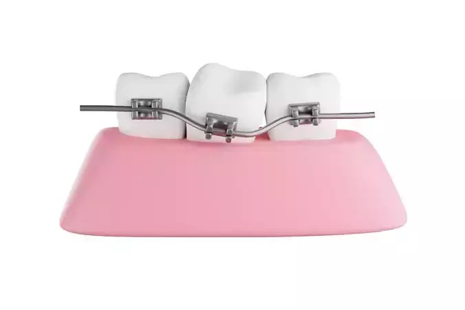 Dental braces system for bite correction