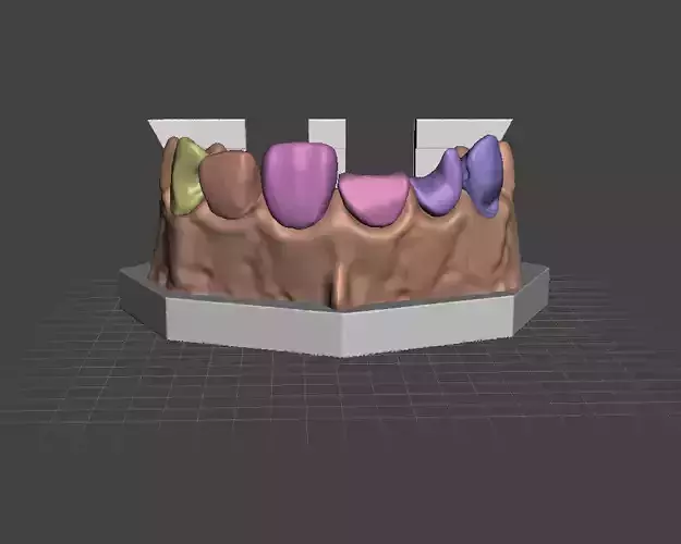 Segmented Anterior Class 5 Class III Class IV Direct Veneer  3D print model