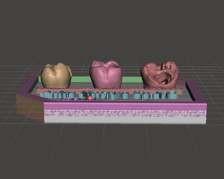 Posterior real case by EDM DENTAL PRACTICE 3D print model_3