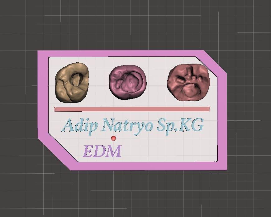 Posterior real case by EDM DENTAL PRACTICE 3D print model_1