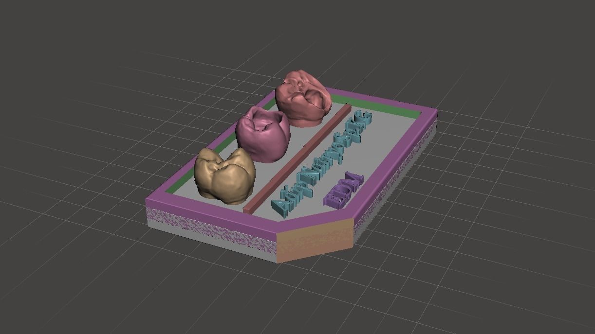 Posterior real case by EDM DENTAL PRACTICE 3D print model_6