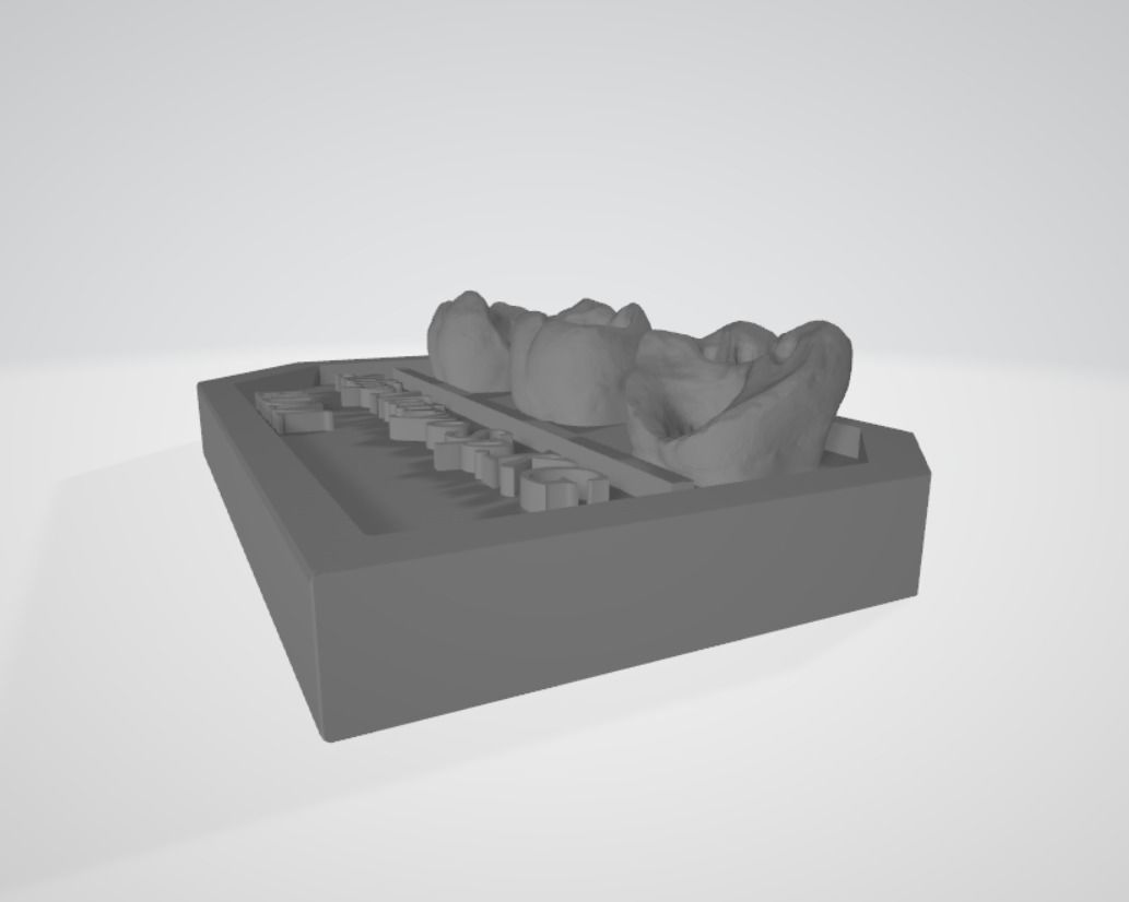 Posterior real case by EDM DENTAL PRACTICE 3D print model_7