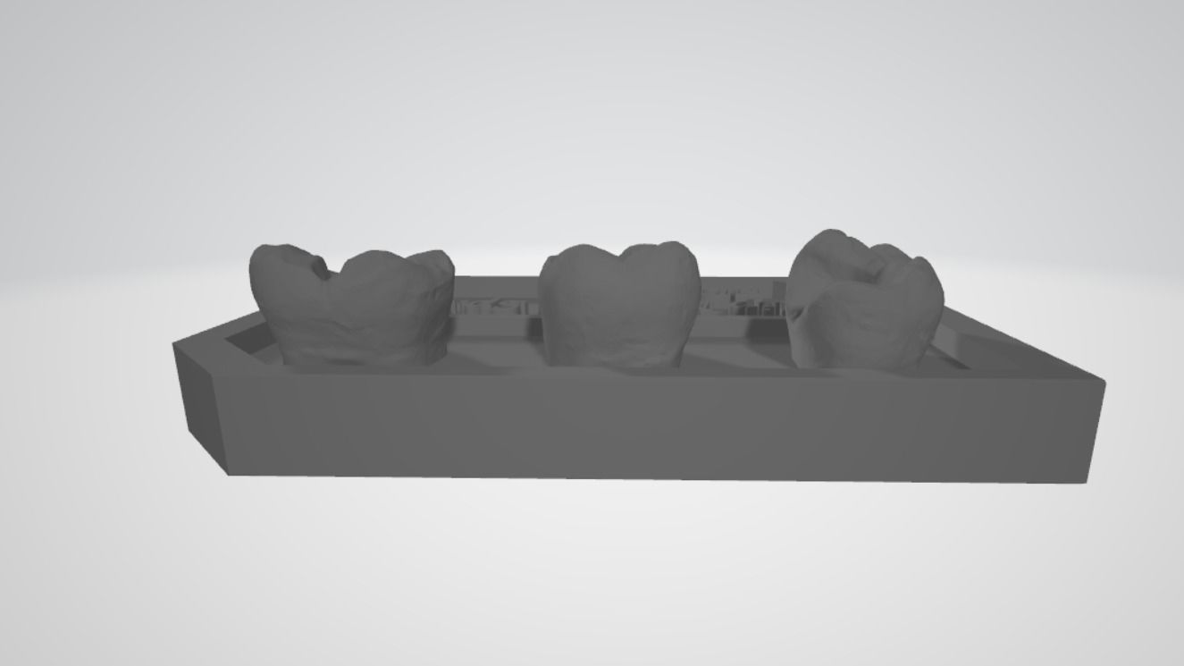 Posterior real case by EDM DENTAL PRACTICE 3D print model_4