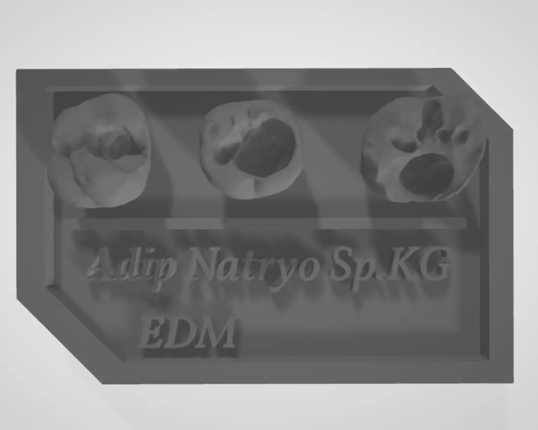 Posterior real case by EDM DENTAL PRACTICE 3D print model_0