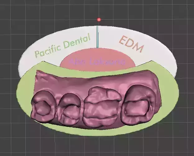 Posterior class 1 MOD Cups Reduction Class II by EDM DENTAL 3D print model