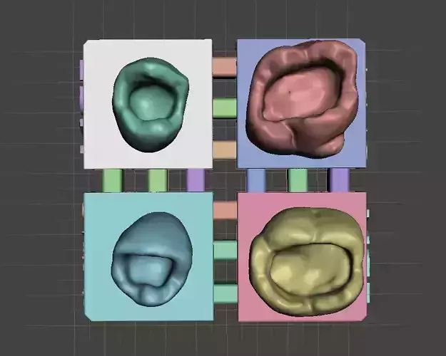 Posterior Block Class 1 by EDM DENTAL PRACTICE 3D print model