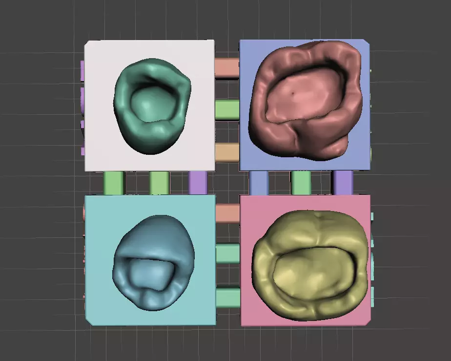 Posterior Block Class 1 by EDM DENTAL PRACTICE 3D print model