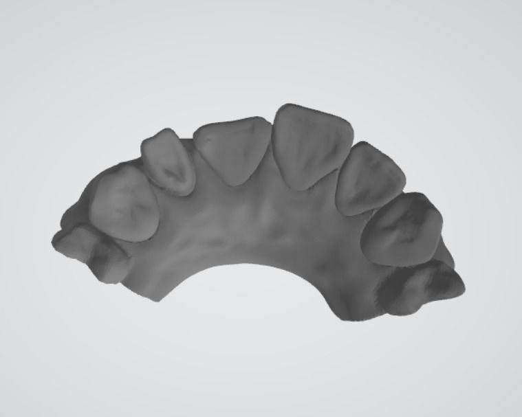 Segmented Anterior Crown Preparation and direct veneer by EDM 3D print model_7
