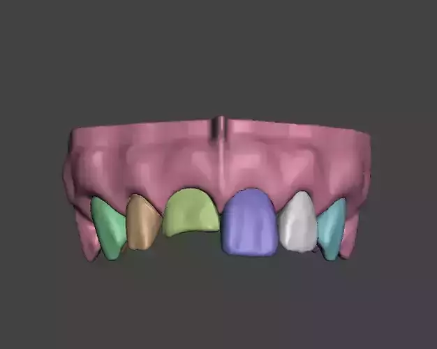 Segmented Anterior Crown Preparation and direct veneer by EDM 3D print model