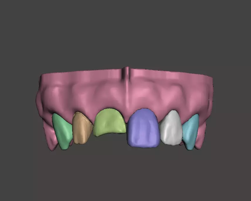 Segmented Anterior Crown Preparation and direct veneer by EDM 3D print model_0
