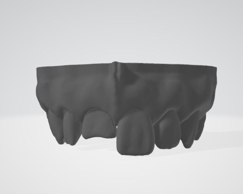 Segmented Anterior Crown Preparation and direct veneer by EDM 3D print model_1