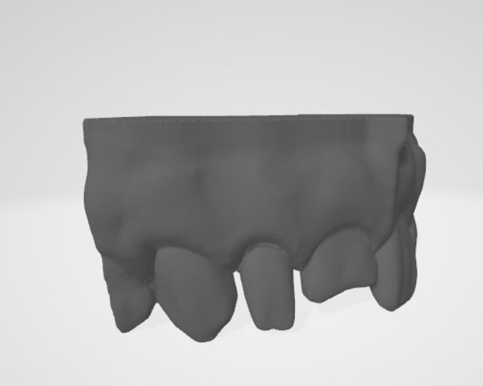 Segmented Anterior Crown Preparation and direct veneer by EDM 3D print model_5