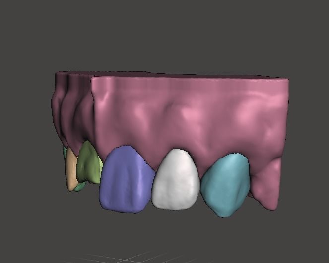 Segmented Anterior Crown Preparation and direct veneer by EDM 3D print model_2