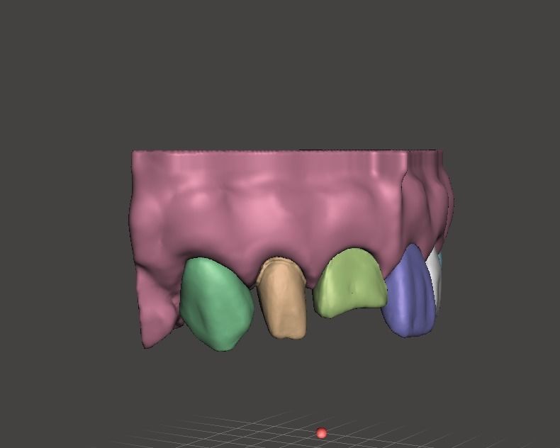 Segmented Anterior Crown Preparation and direct veneer by EDM 3D print model_4