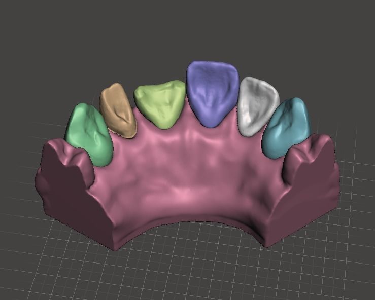 Segmented Anterior Crown Preparation and direct veneer by EDM 3D print model_6