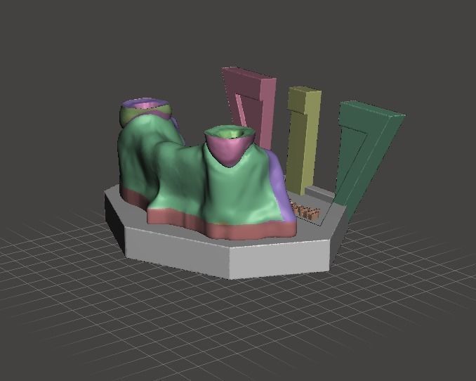 Segmented Canine Decaputation with Root Canal by EDM DENTAL 3D print model_7