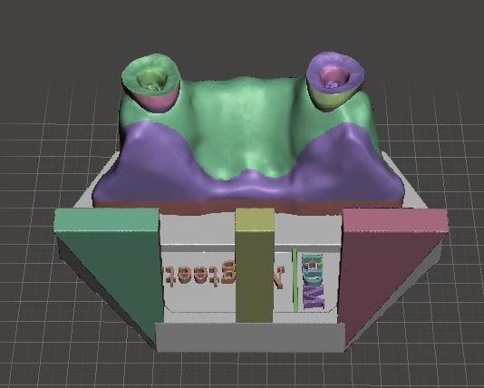 Segmented Canine Decaputation with Root Canal by EDM DENTAL 3D print model_9