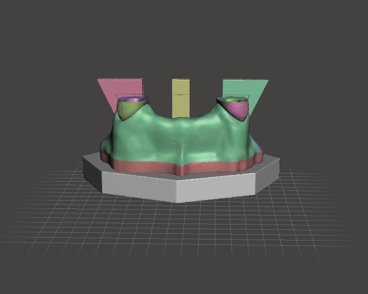 Segmented Canine Decaputation with Root Canal by EDM DENTAL 3D print model_1