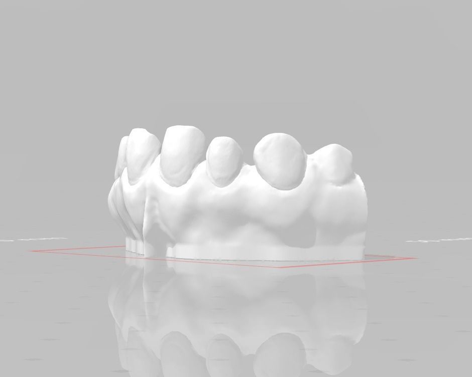 Segmented Anterior Veneer Preparation by EDM DENTAL PRACTICE 3D print model_2