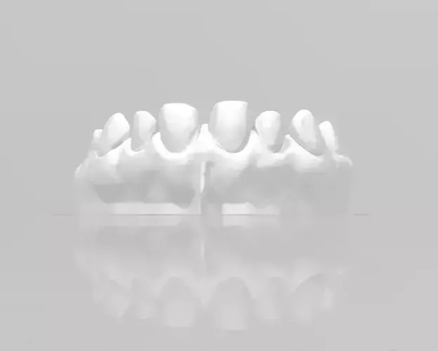 Segmented Anterior Veneer Preparation by EDM DENTAL PRACTICE 3D print model Segmented Anterior Veneer Preparation by EDM DENTAL PRACTICE 3D print model