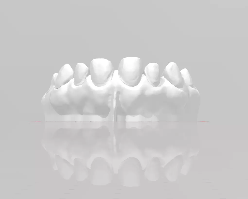 Segmented Anterior Veneer Preparation by EDM DENTAL PRACTICE 3D print model_0