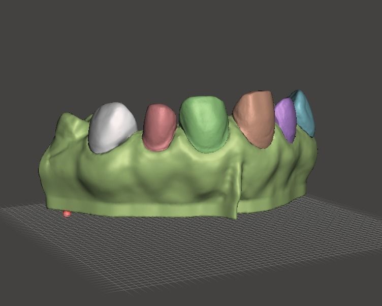 Segmented Anterior Veneer Preparation by EDM DENTAL PRACTICE 3D print model_5