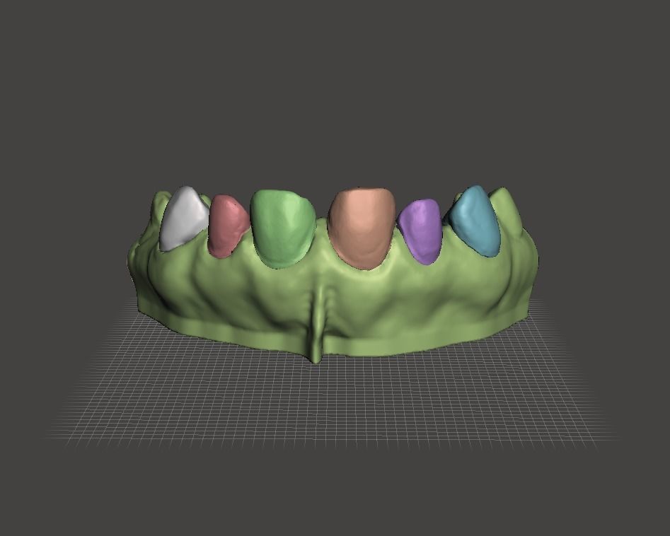 Segmented Anterior Veneer Preparation by EDM DENTAL PRACTICE 3D print model_1