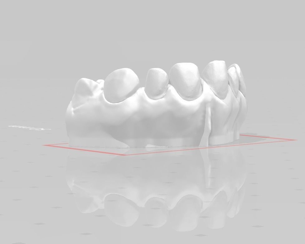 Segmented Anterior Veneer Preparation by EDM DENTAL PRACTICE 3D print model_4