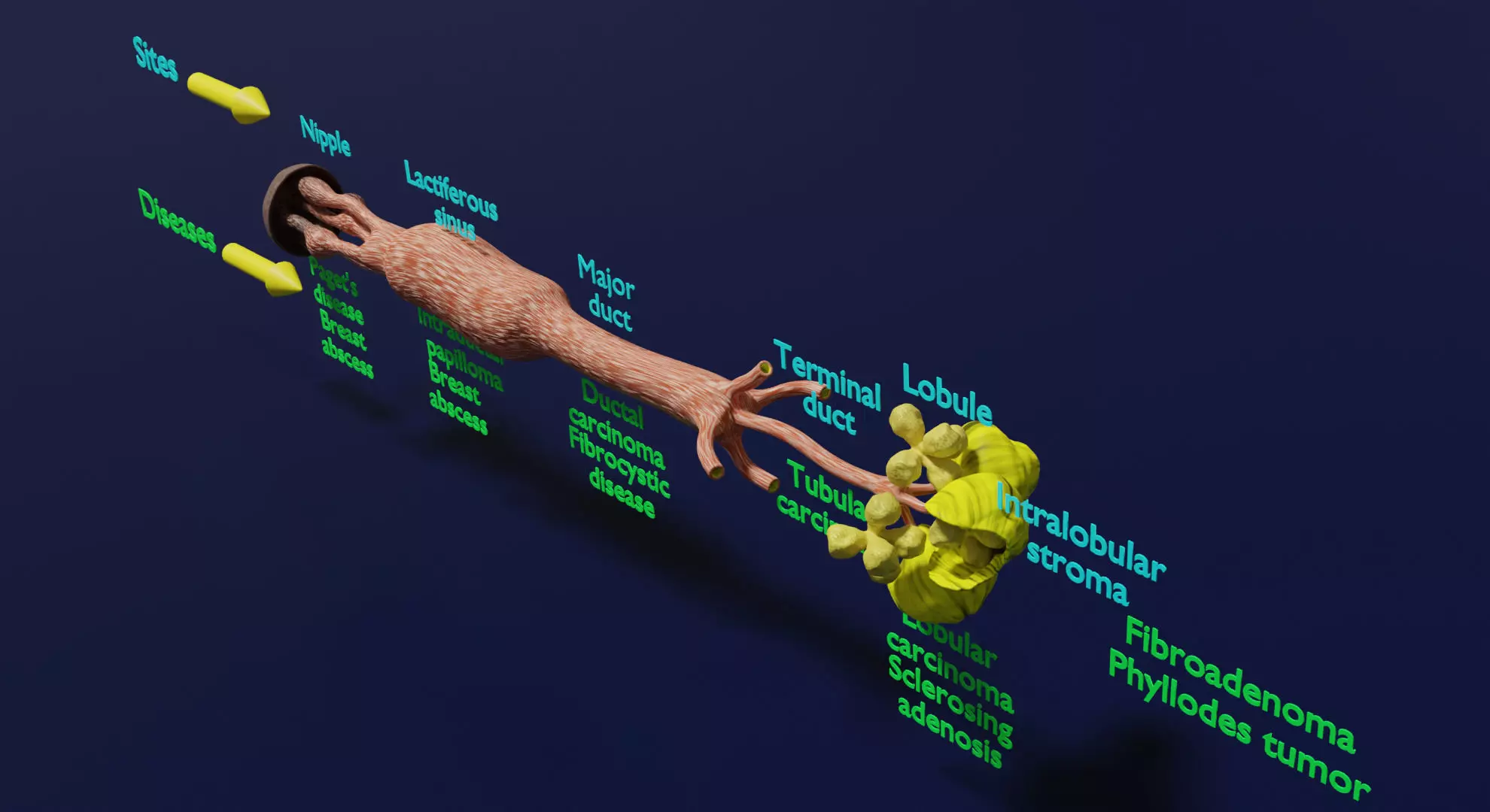 duct sites and diseases 3D model