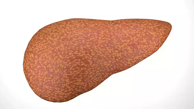 cirrhosis  3D model