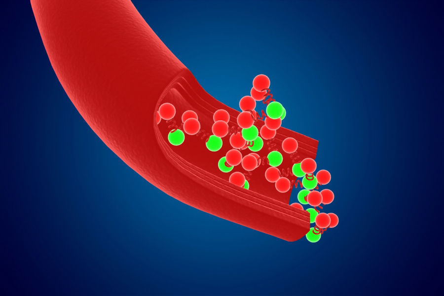 Artery Vein Clog Clot Clogged Stream Bloodflow Layers Section 3D model_3
