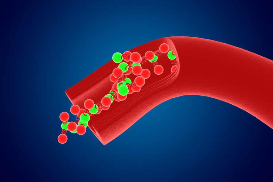 Artery Vein Clog Clot Clogged Stream Bloodflow Layers Section 3D model_2