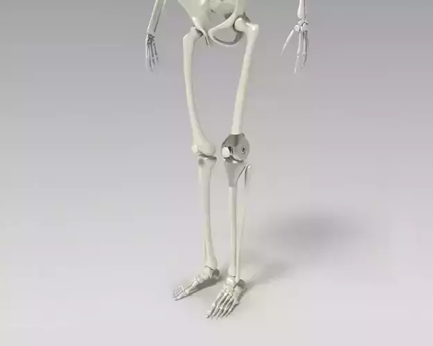 Knee Tumor Prosthesis 3D model