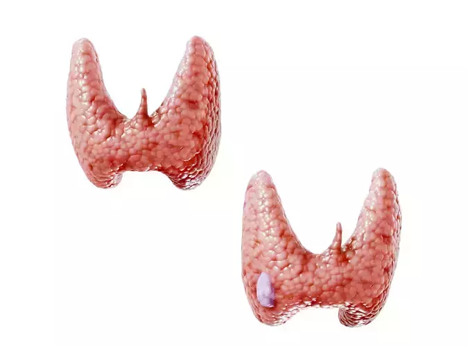 Healthy Thyroid and Thyroid Cancer Low-poly 3D model