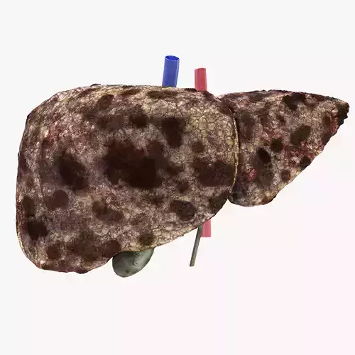 Hepatocellular Carcinoma Liver Low-poly 3D model