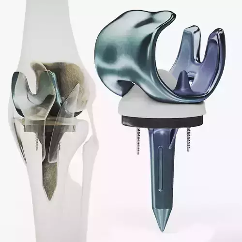 Replaced Knee Implant Low-poly 3D model